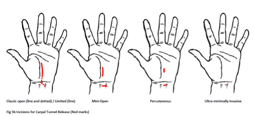 Ultrasound Guided Carpal Tunnel Release Incision