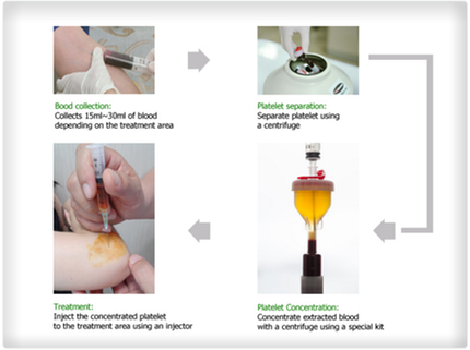 prp-or-platelet-rich-plasma_med